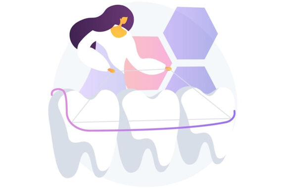 erosione dentale e sport